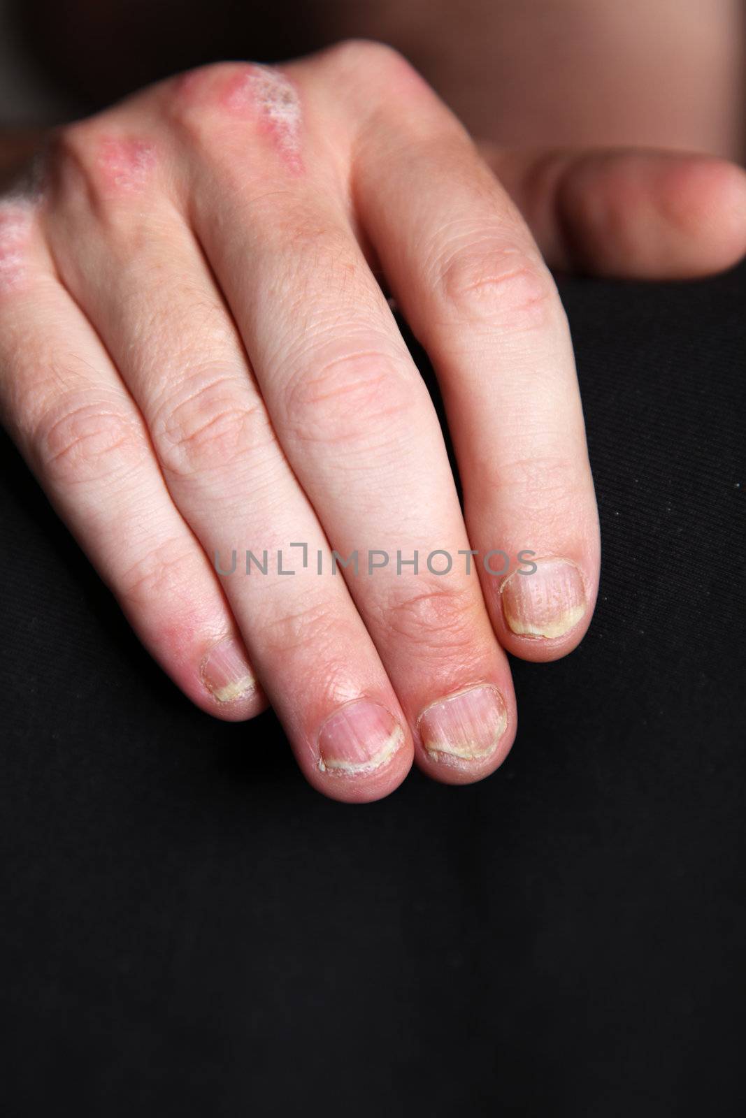 Nahaufnahme-Severe psoriasis - psoriasis of the fingernails and the hand - close up
