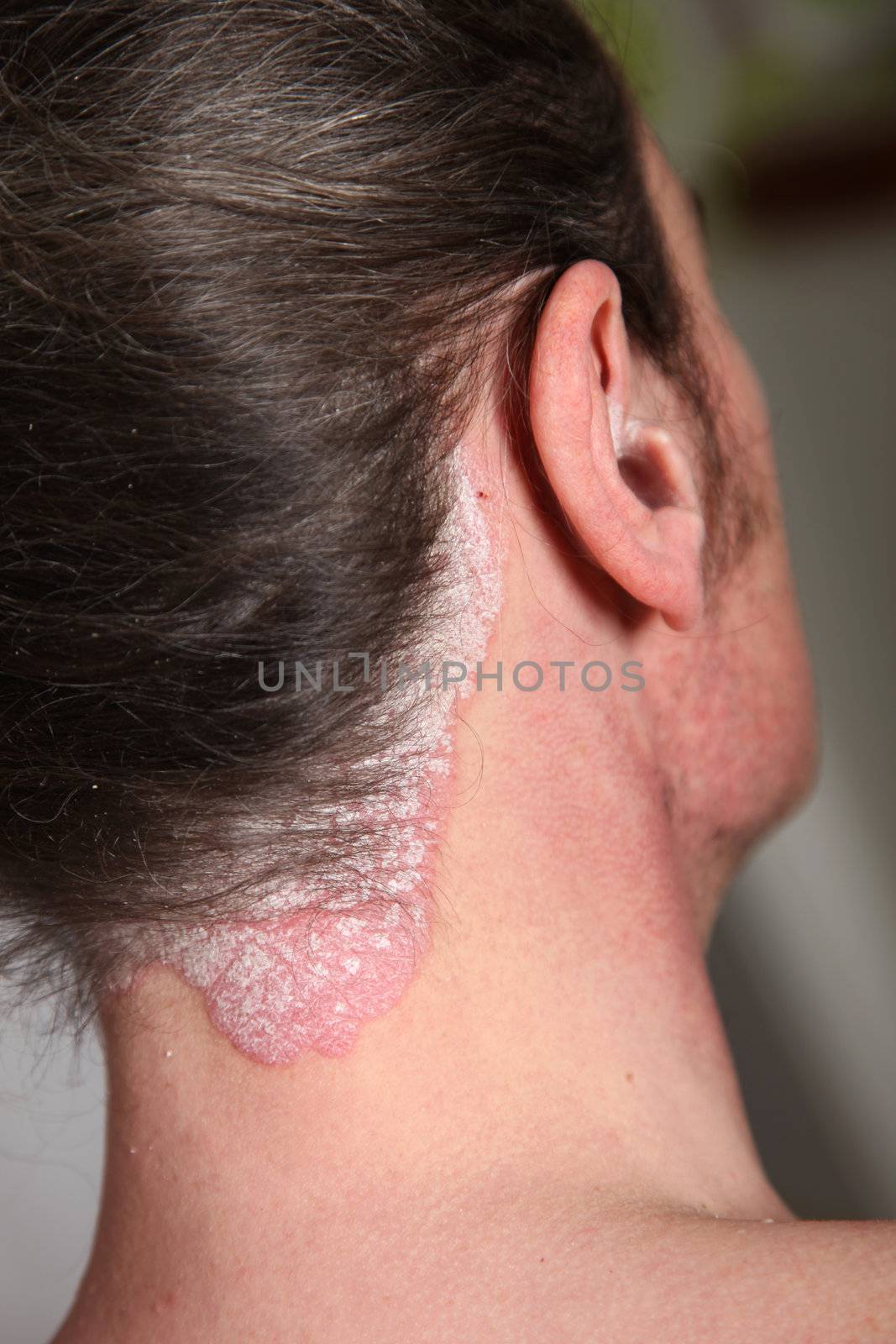 Severe psoriasis neck and neck as well as in the ear by Farina6000