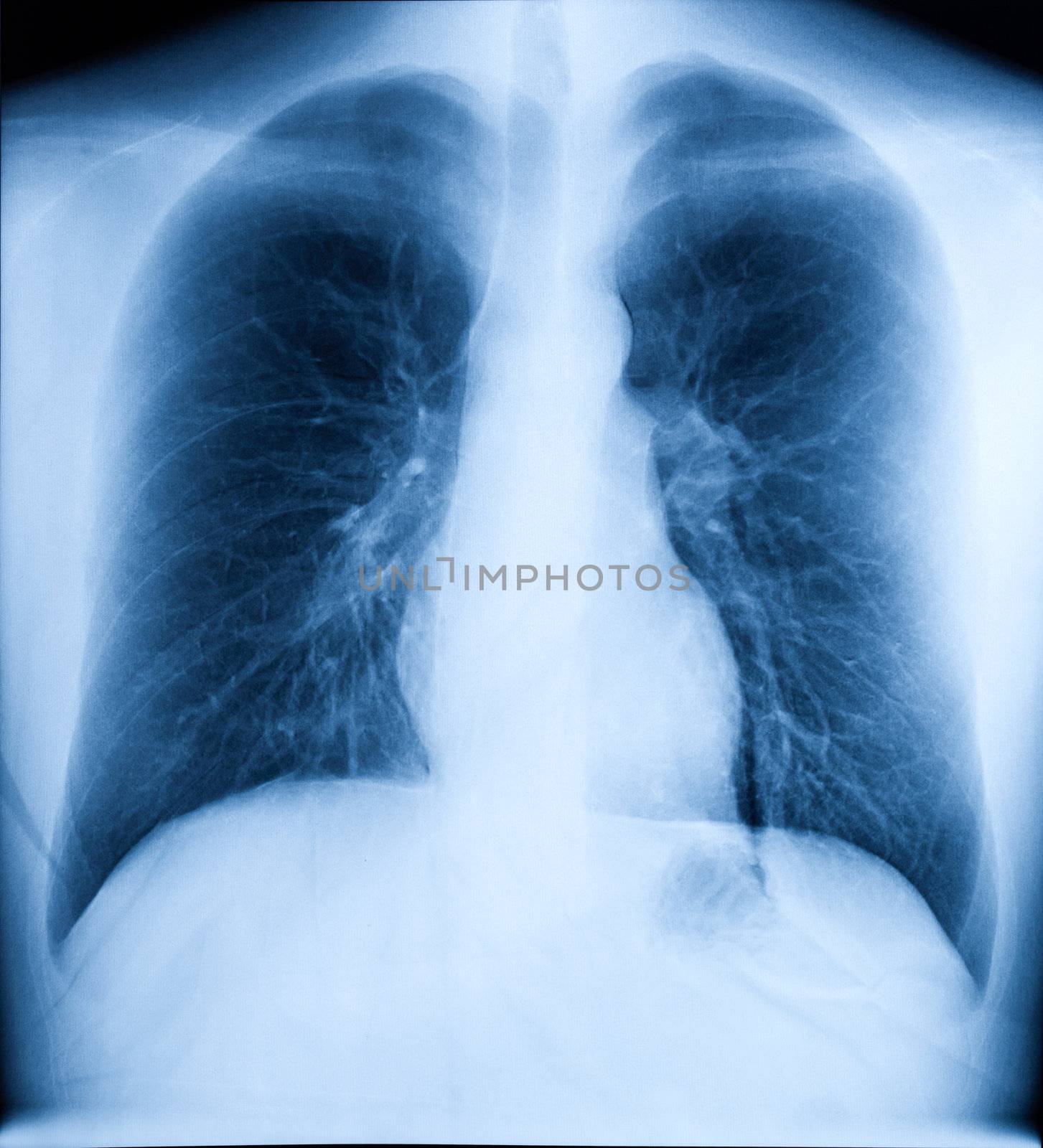 X-Ray Image Of Human Chest by dimol