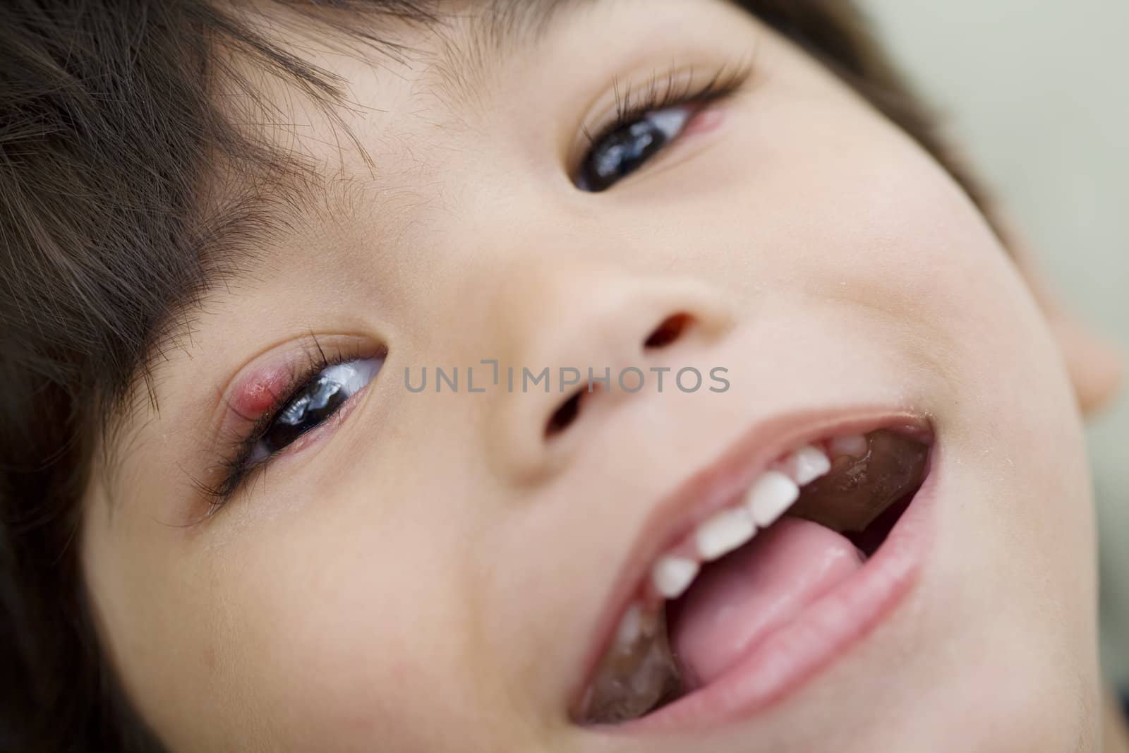 Little boy with a sty on his eye smiling at camera