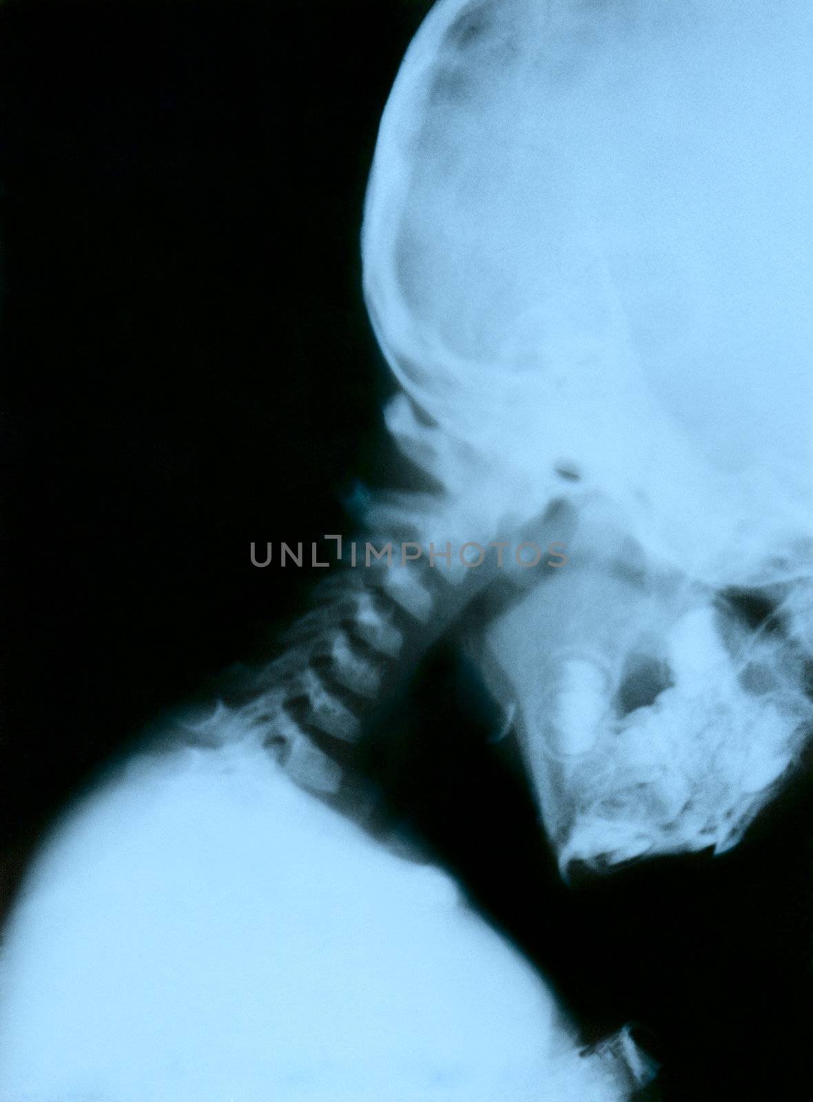 Displacement third vertebra. Child 3 years. Scanned from the film