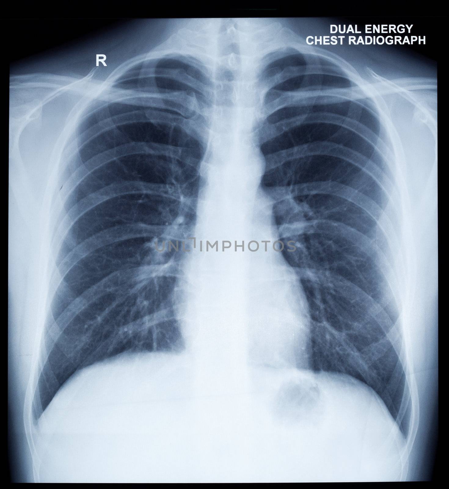 X-Ray Image Of Human Chest by dimol