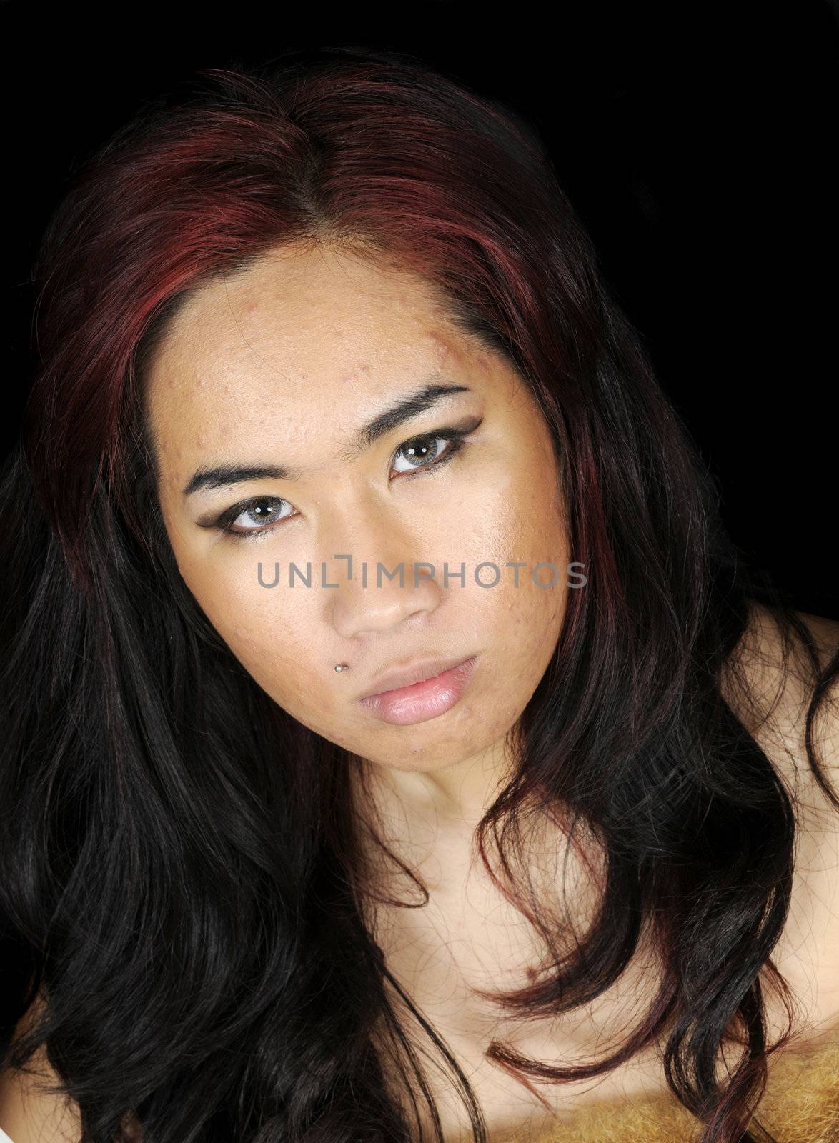 young brunette asian woman with bad case of acne