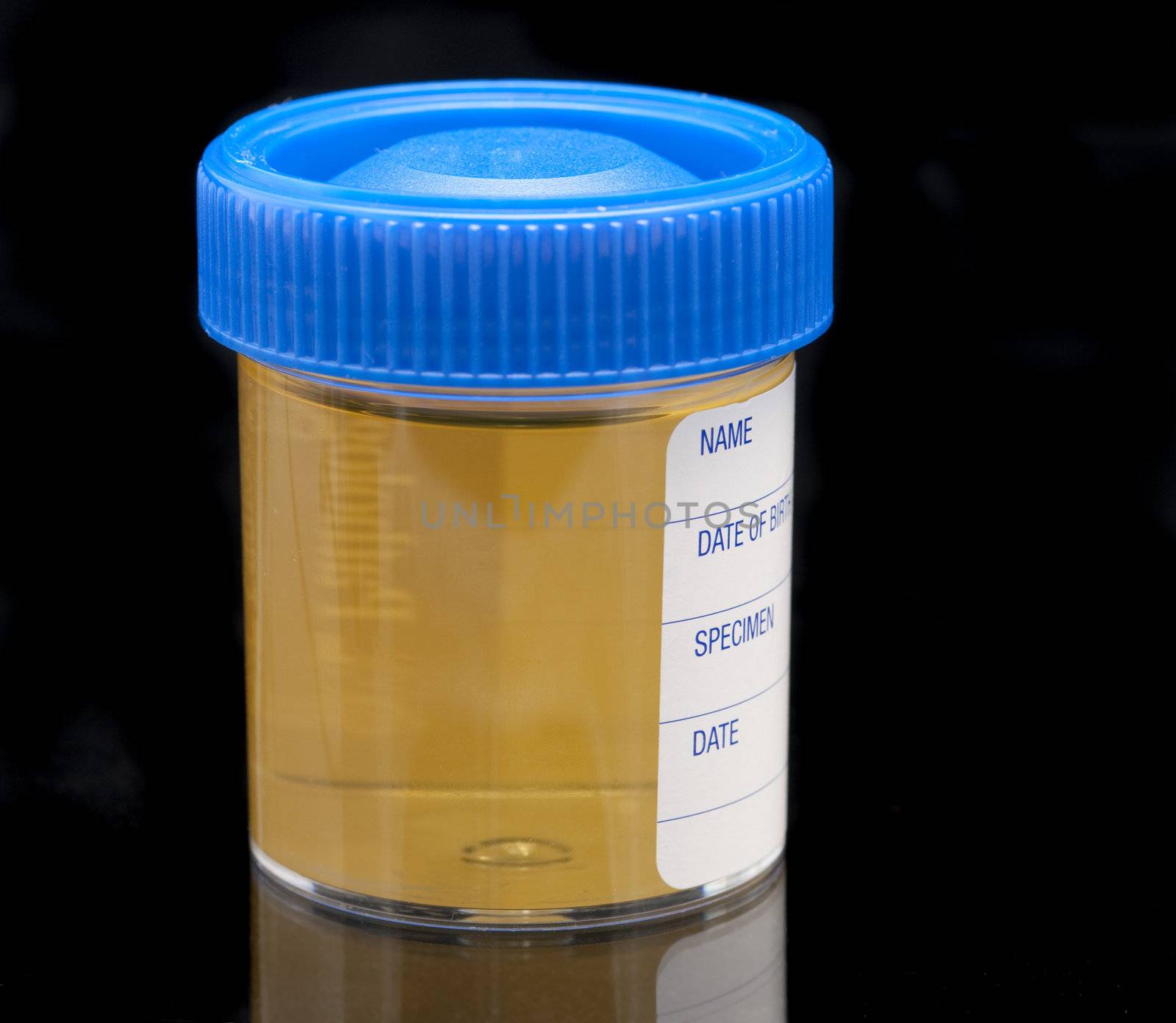 pathology test jar containing a urine sample on a dark background