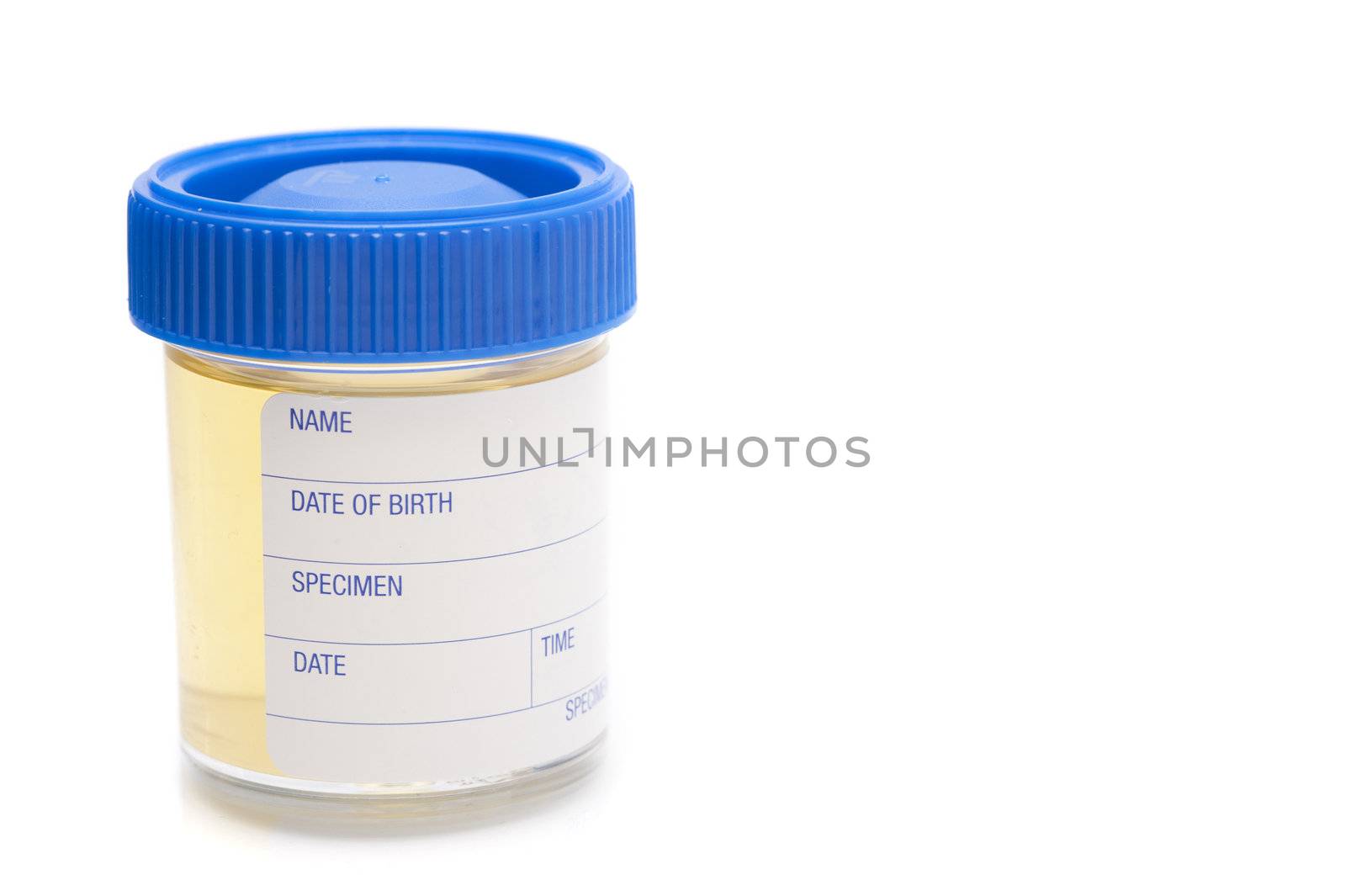 pathology test sample jar containing a urine specimen