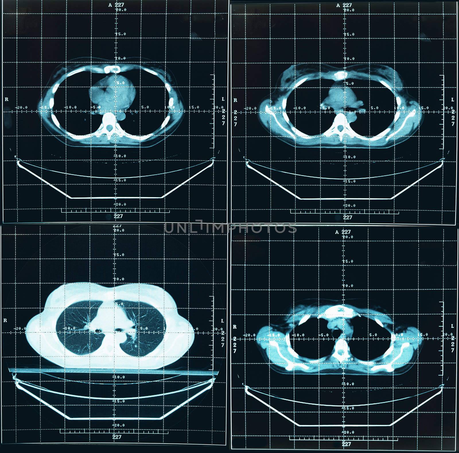 Four images - tomography of human thorax
