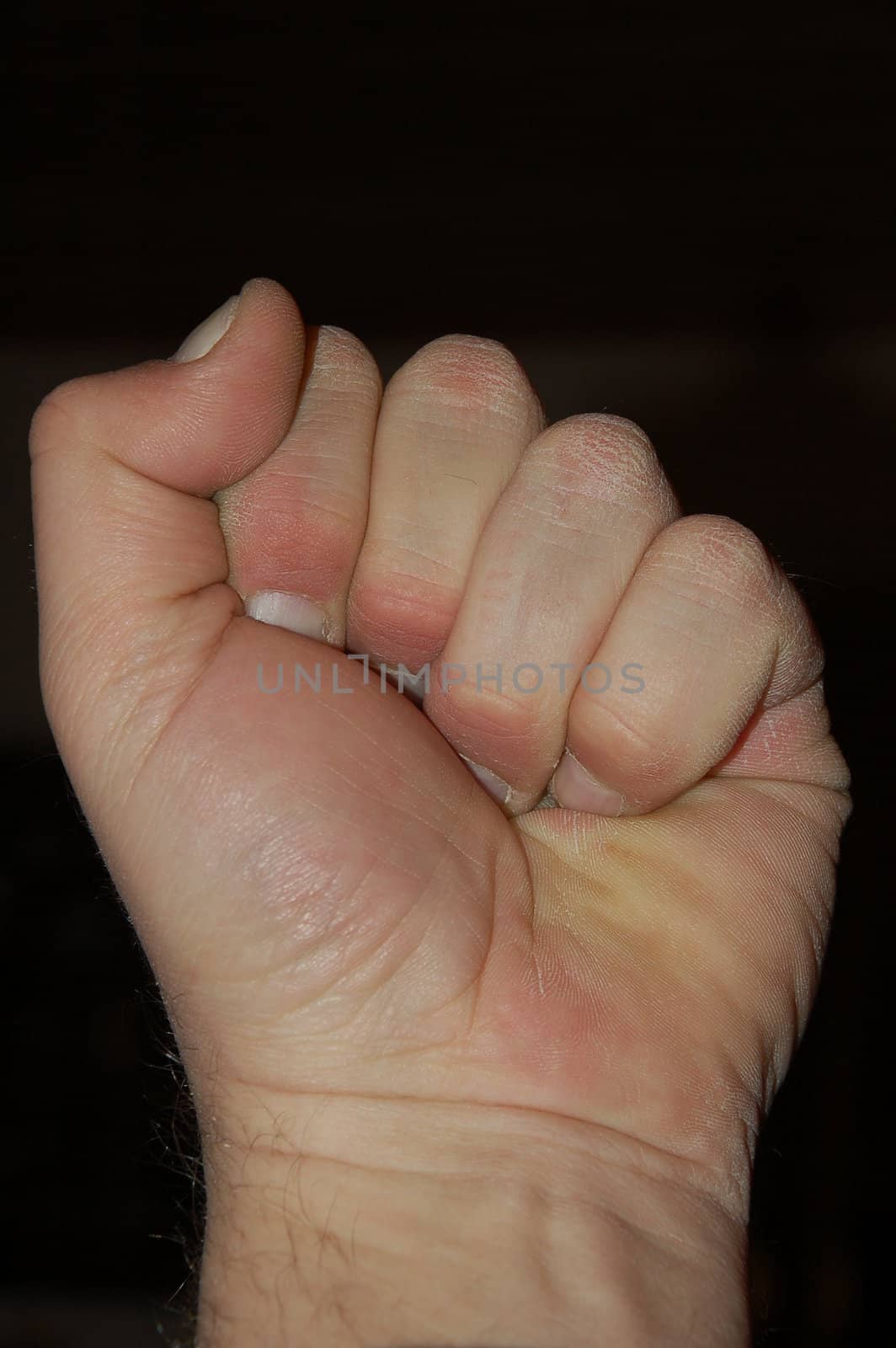 Closed fist with dry skin