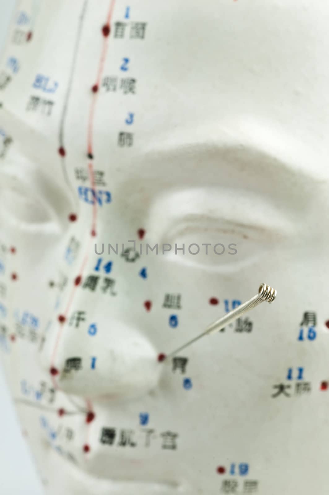 Acupuncture needle