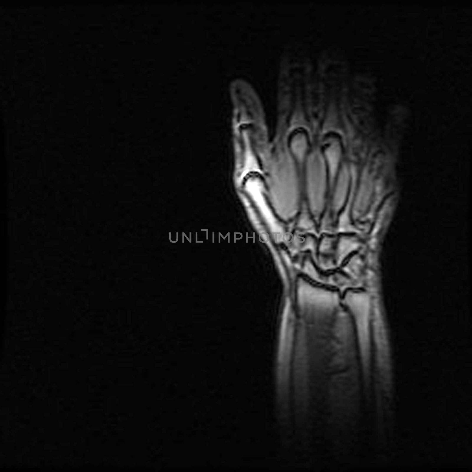 a healthy hand of an X-ray photo