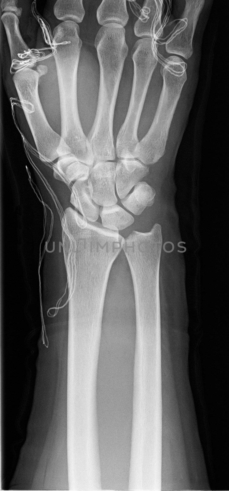 a healthy hand of an X-ray photo