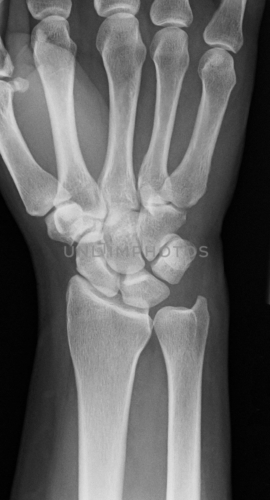 a healthy hand of an X-ray photo