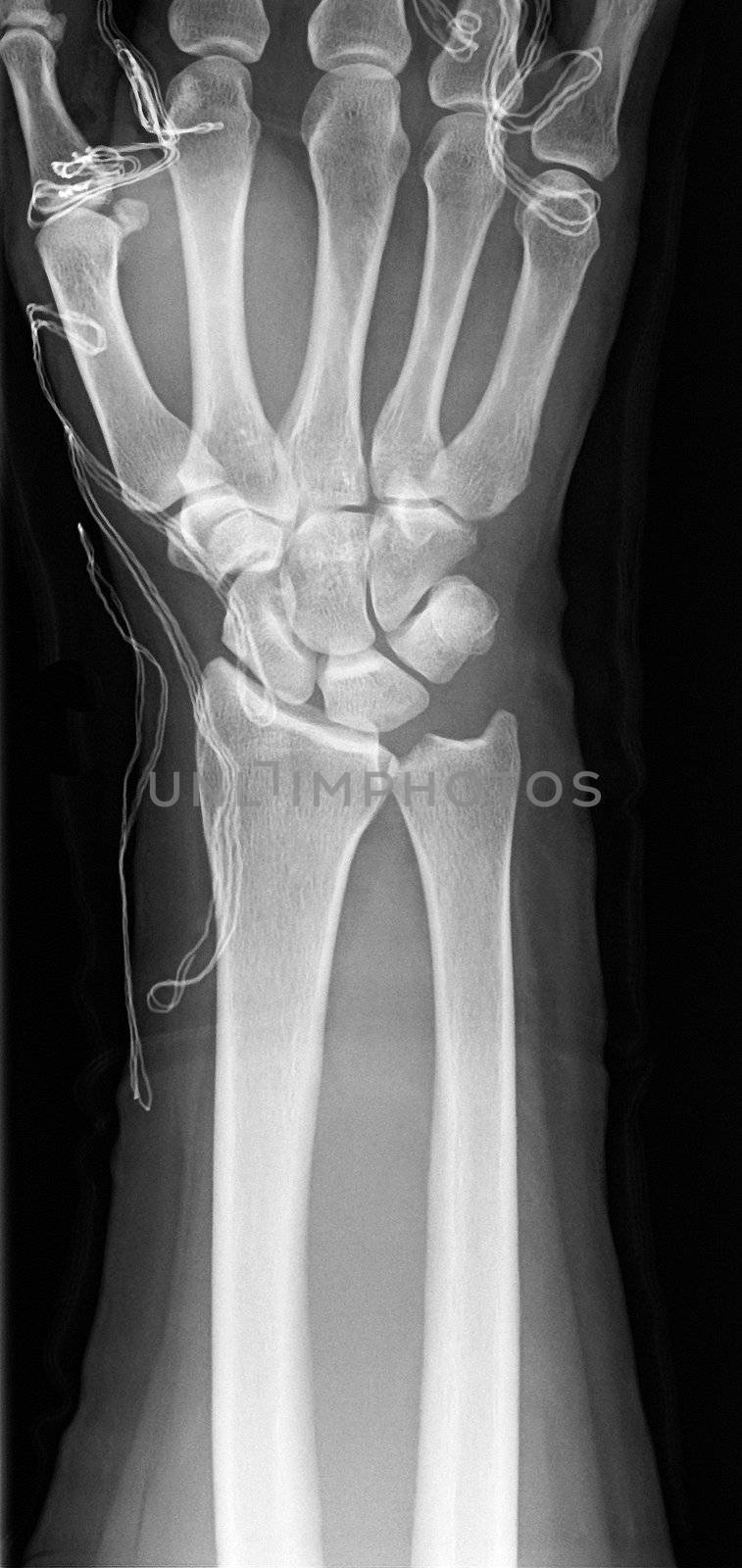 a healthy hand of an X-ray photo