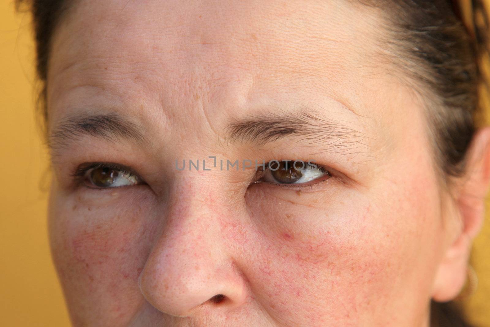 Allergies - swollen eyes and face - close-up