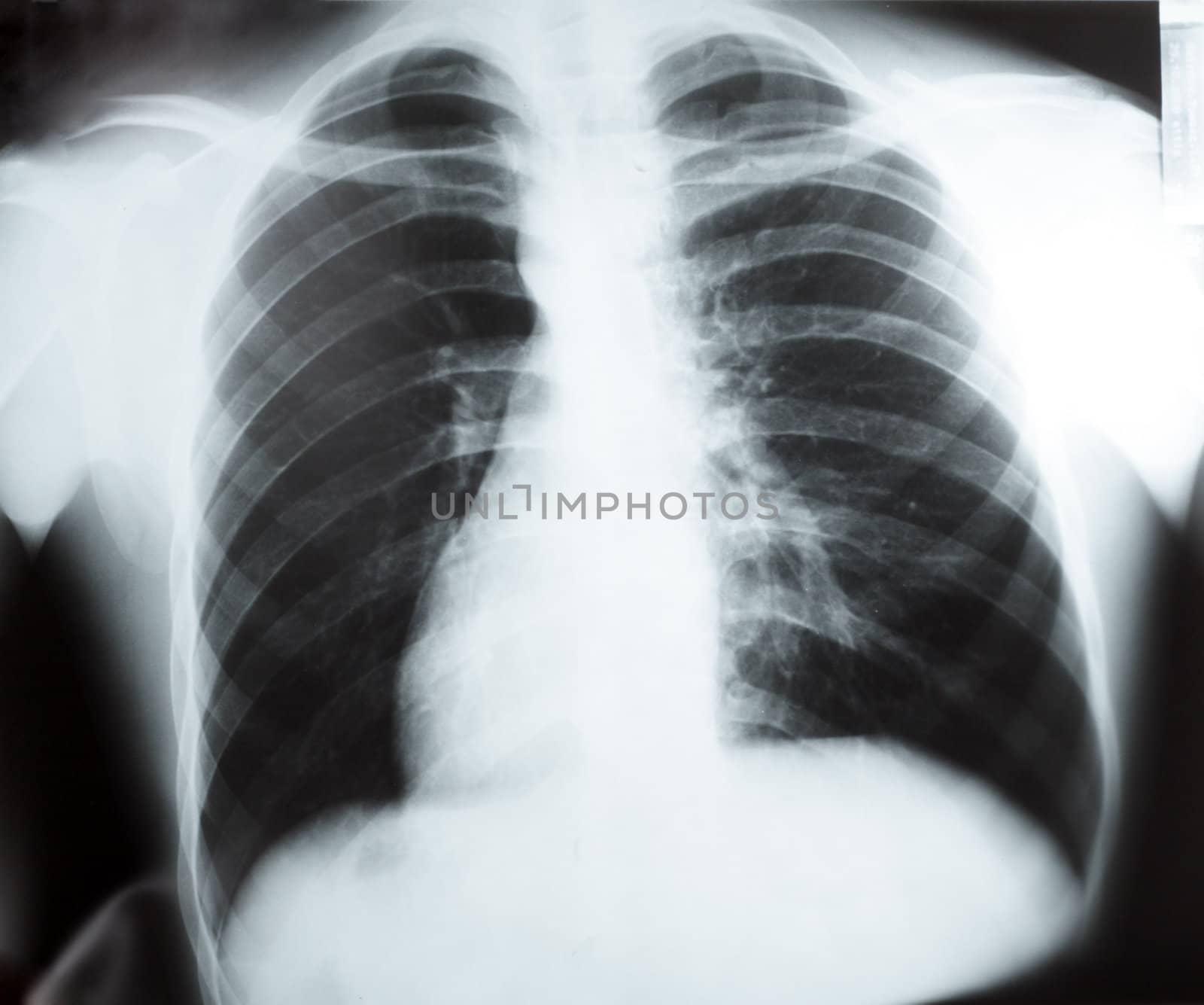 X-ray of chest on previewer, black and white