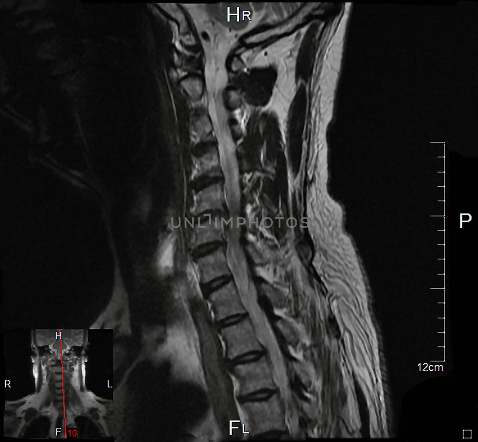 a magnetic resonance imaging of the cervical spine of a human