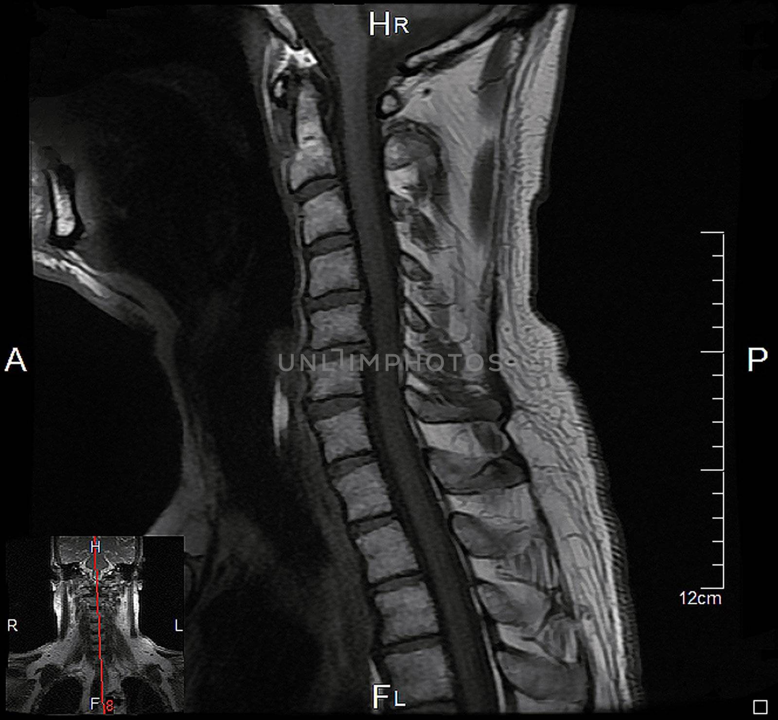 a magnetic resonance imaging of the cervical spine of a human