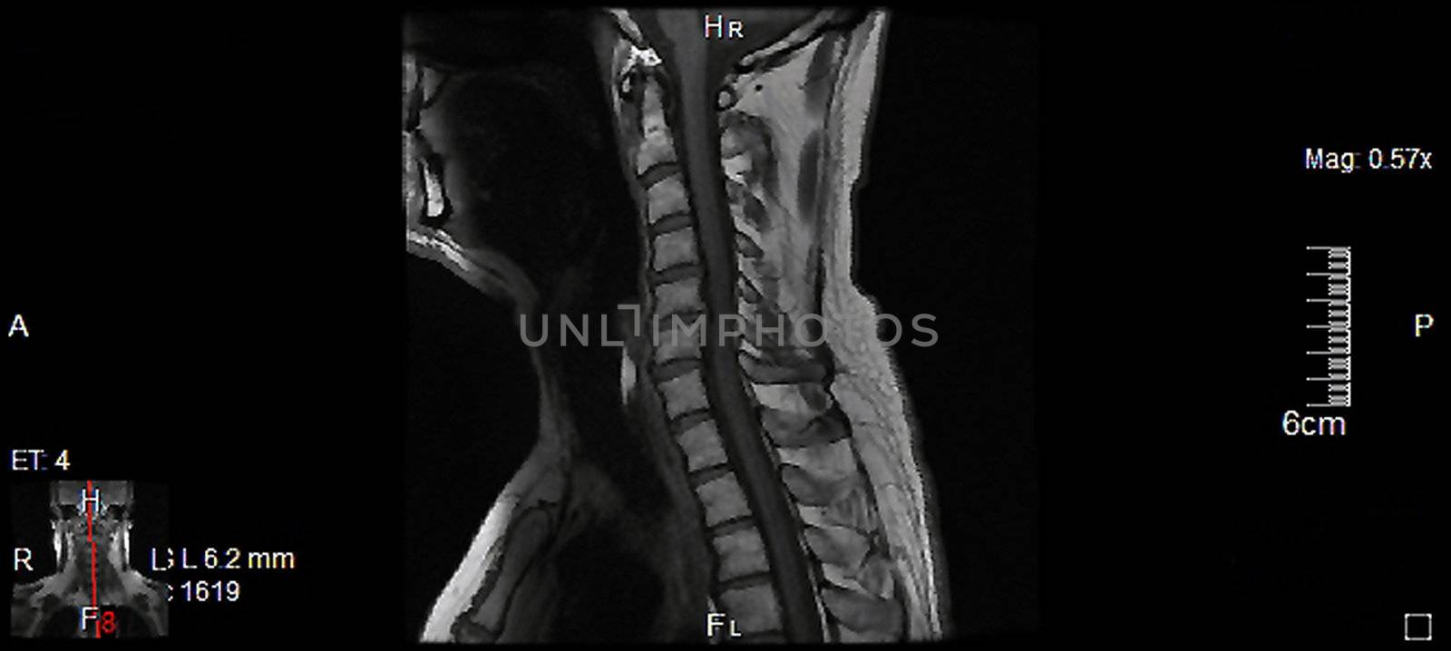 MRT,a magnetic resonance imaging of the cervical spine of a human