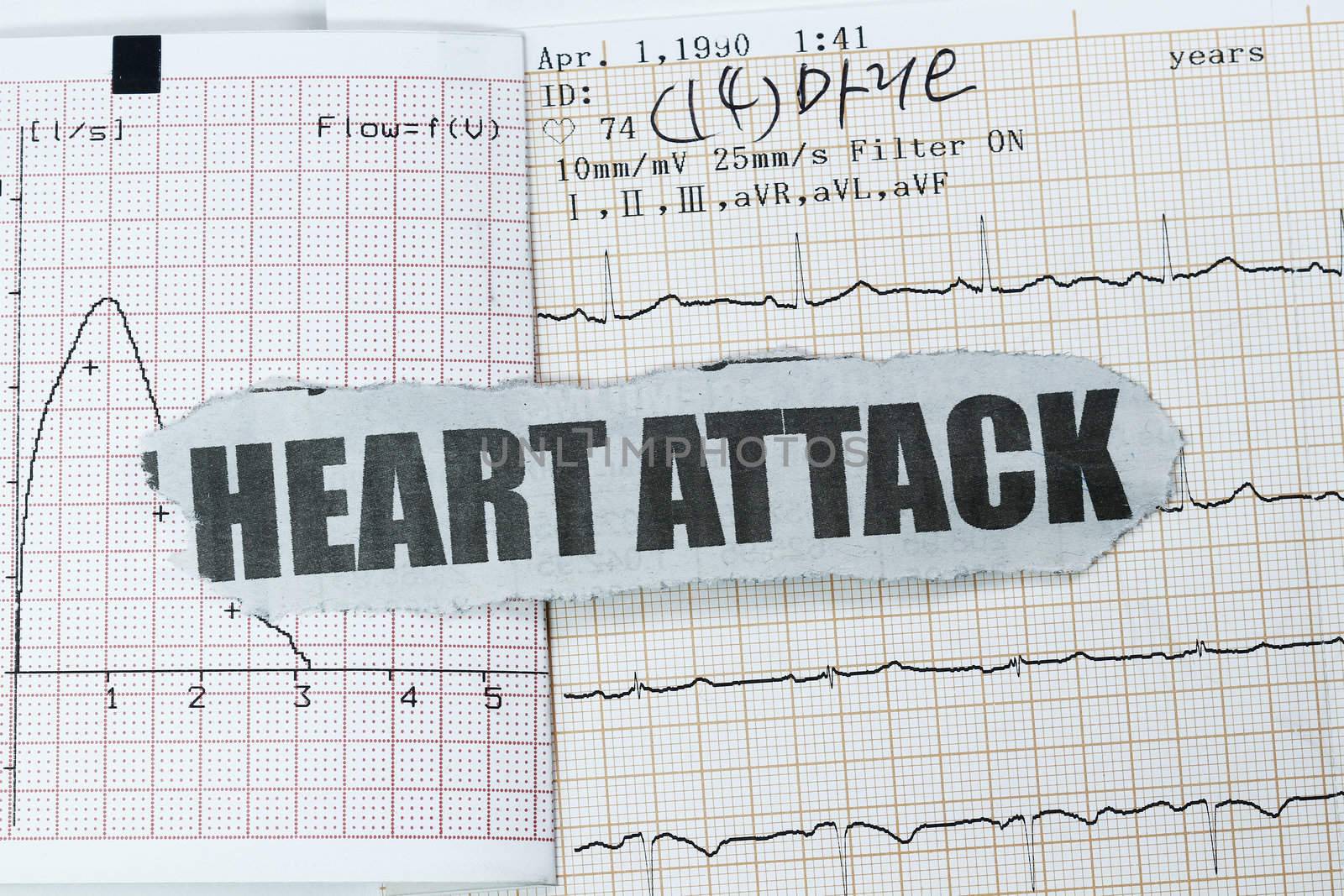 Actual EKG/ECG examination result with bold text heart attack.
