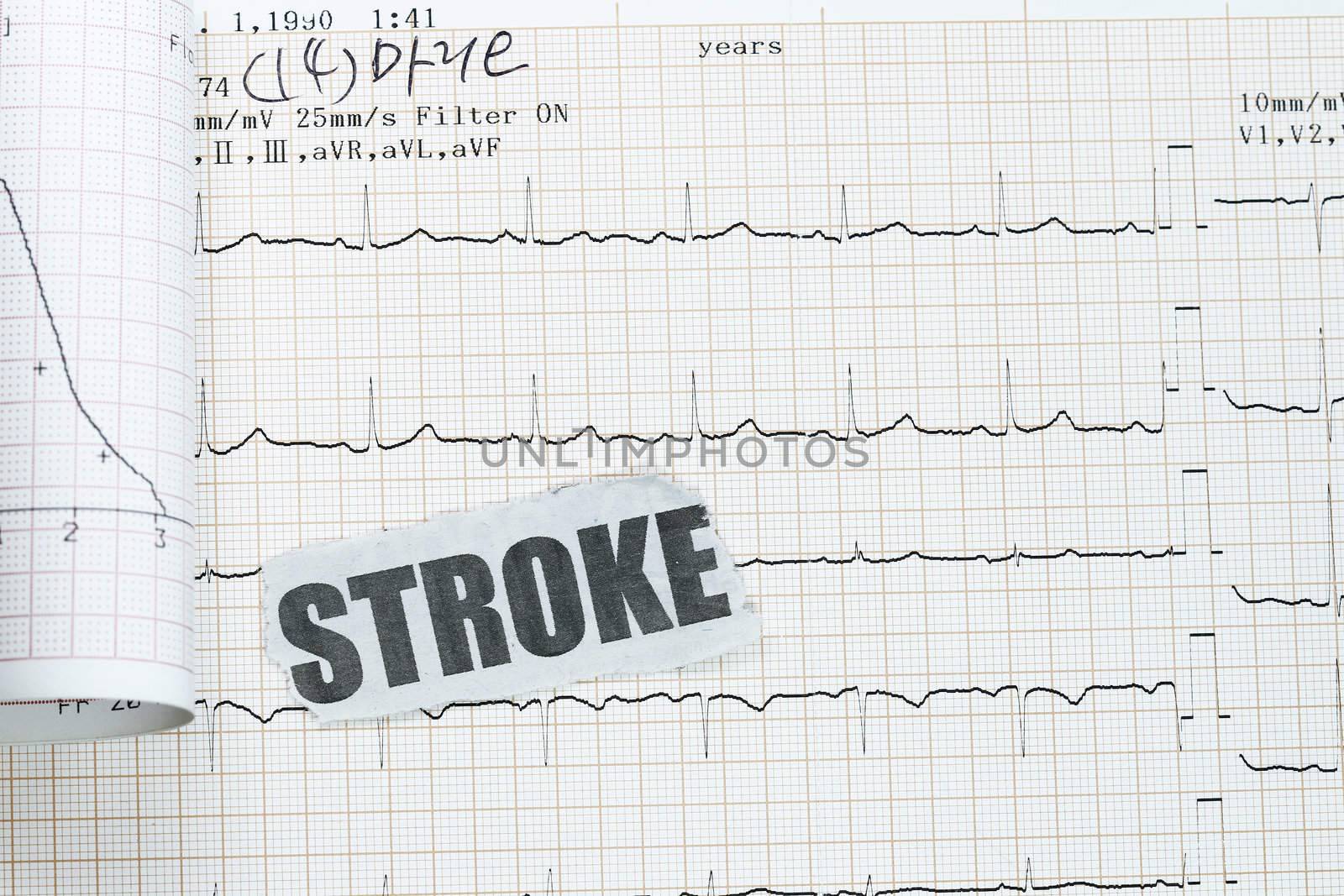 Stroke with actual ecg ekg chart - many uses in medical purpose.