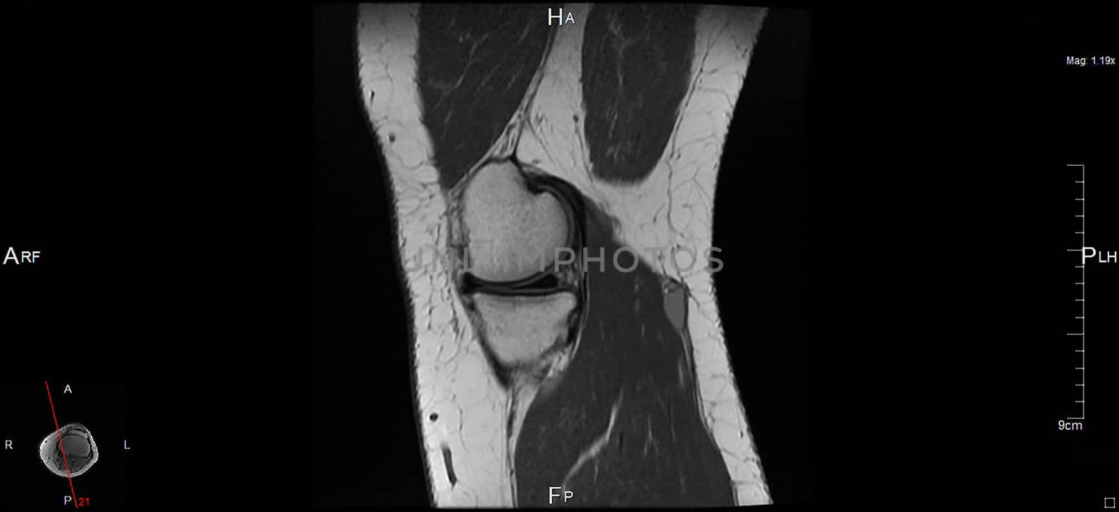 a magnetic resonance imaging
of the left knee, a human