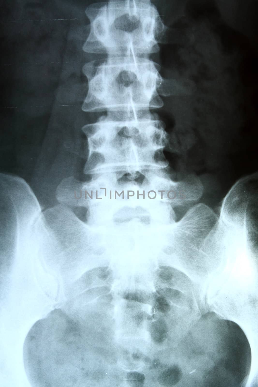 X-ray of the pelvis and spinal column. 