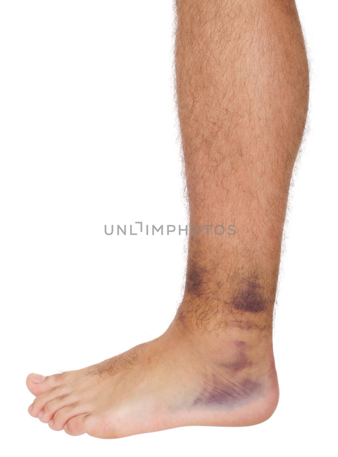 young male with sprained ankle isolated on white background 