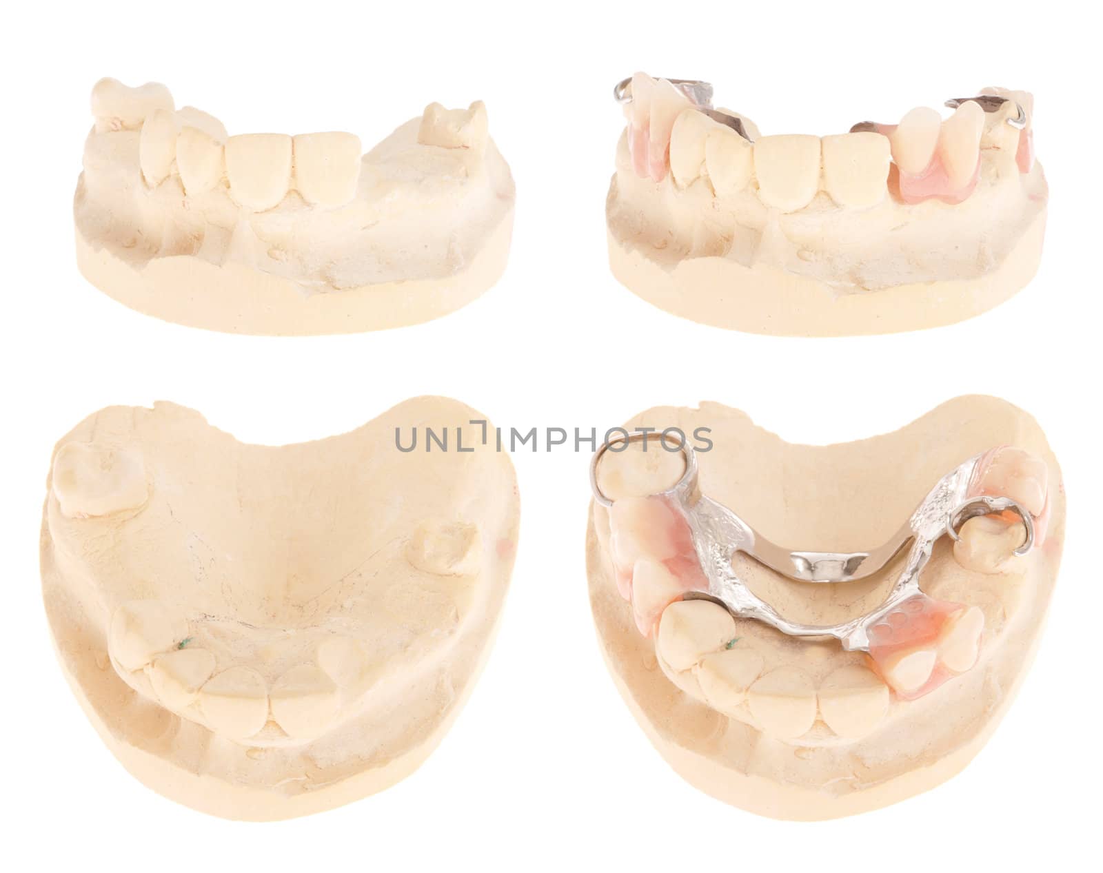 cast model with missing teeth and with chrome cobalt denture (isolated on white background)