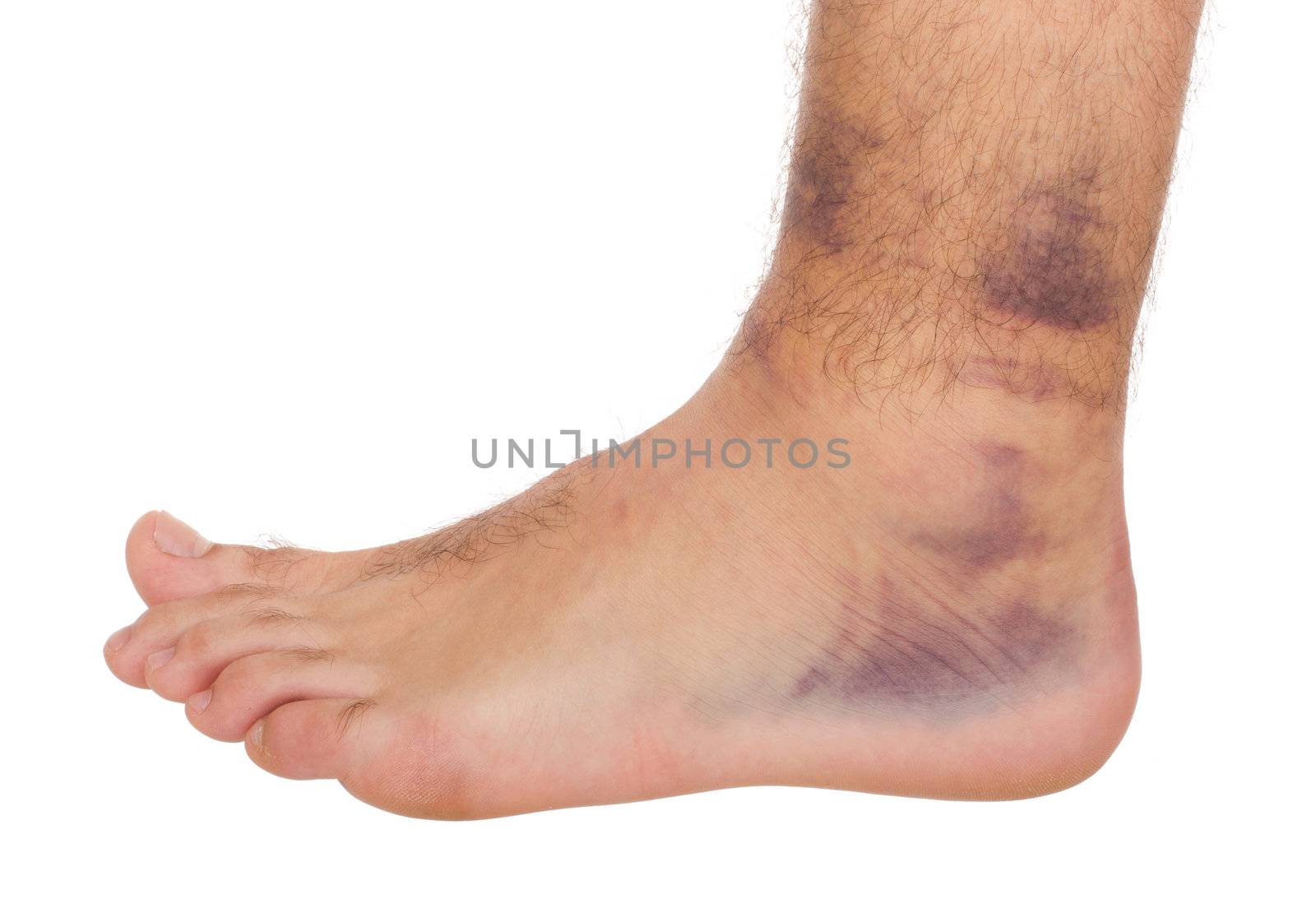 young male with sprained ankle isolated on white background 