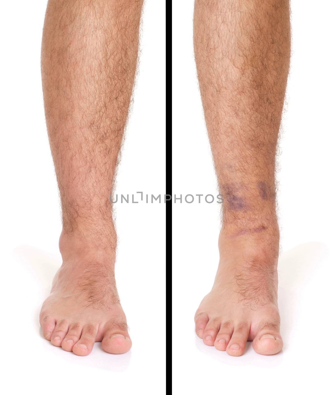 young male with sprained ankle isolated on white background (healthy vs unhealthy)