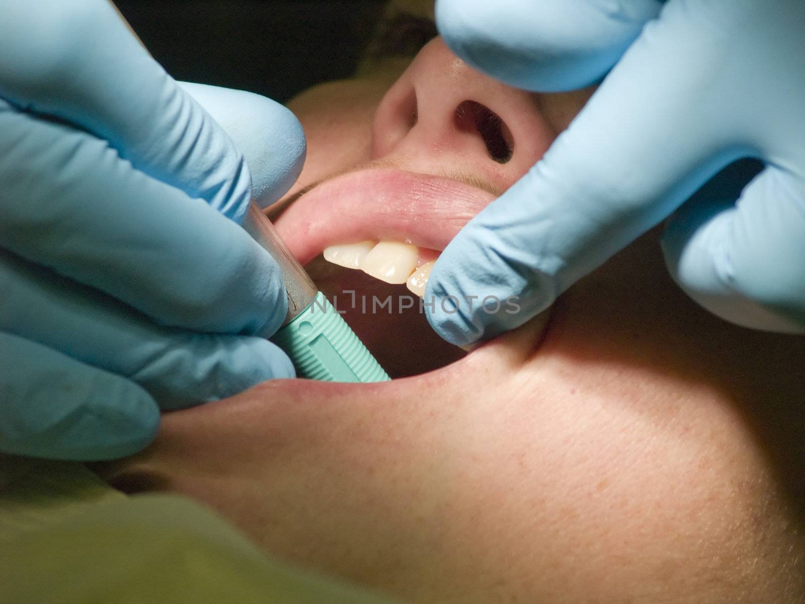 A closeup of a dental hygienist checking a patient's teeth for cavities.