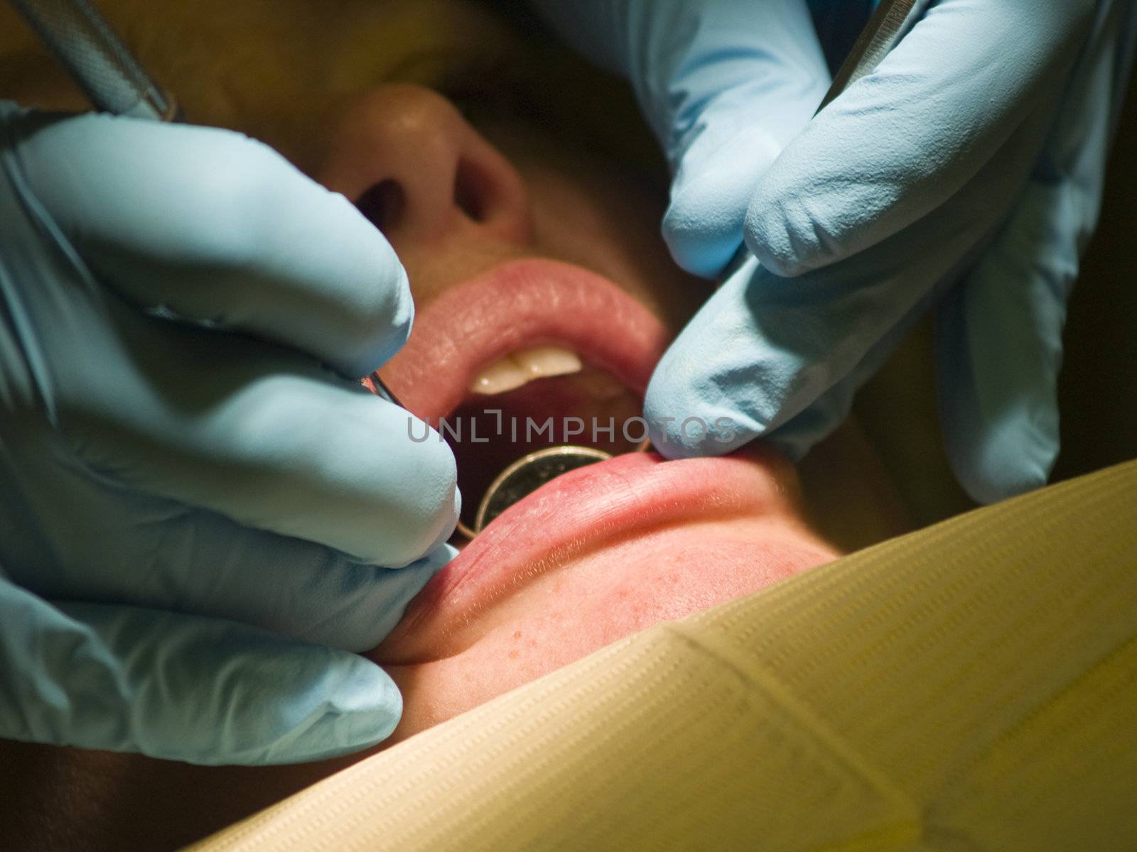 A dentist's hands holding tools and inspecting a woman's smile for cavities. Closeup of the woman's mouth and the doctor's hands