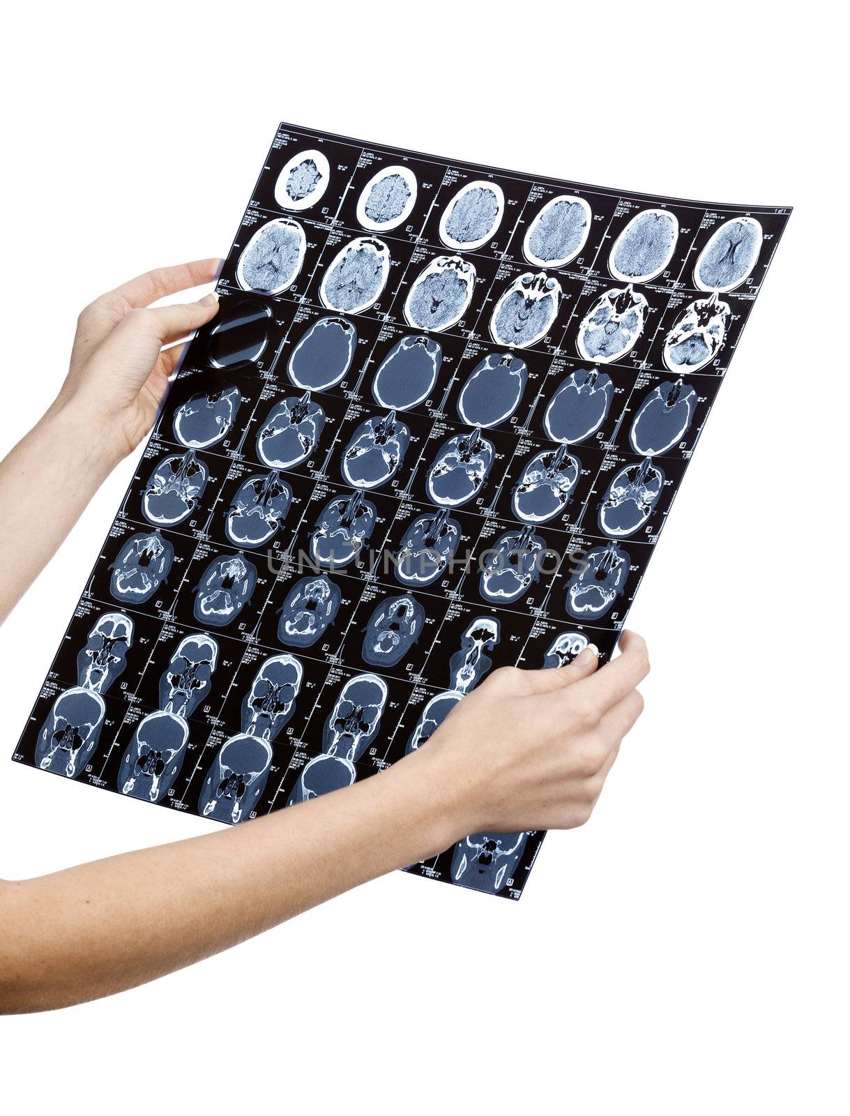 Doctor's hands with mri of human head, isolated on white background