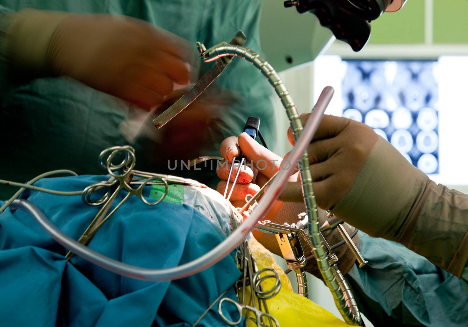 Close-up of doctor's hands performing brain surgery