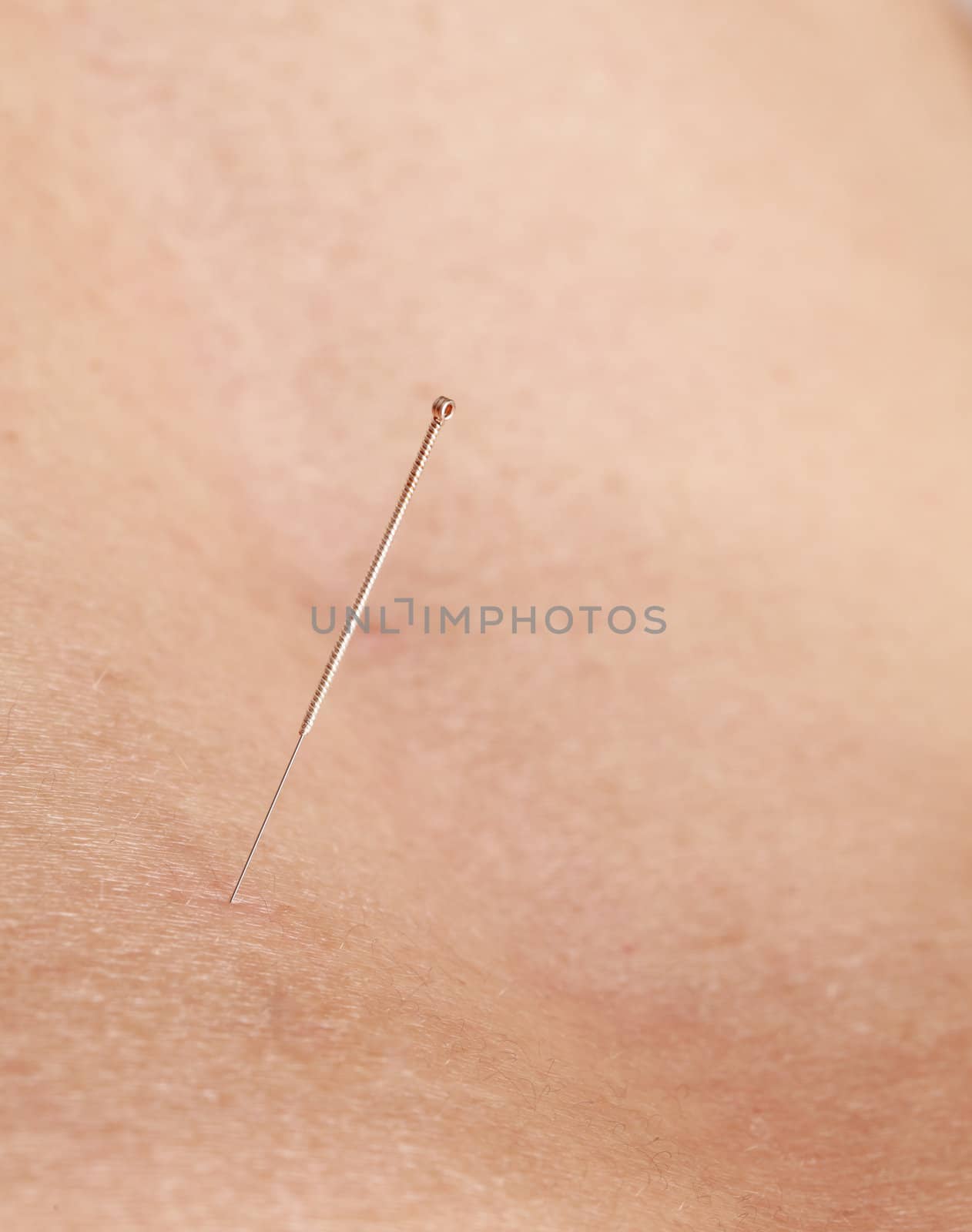 Macro image of an acupuncture needle in the skin of a pacient.