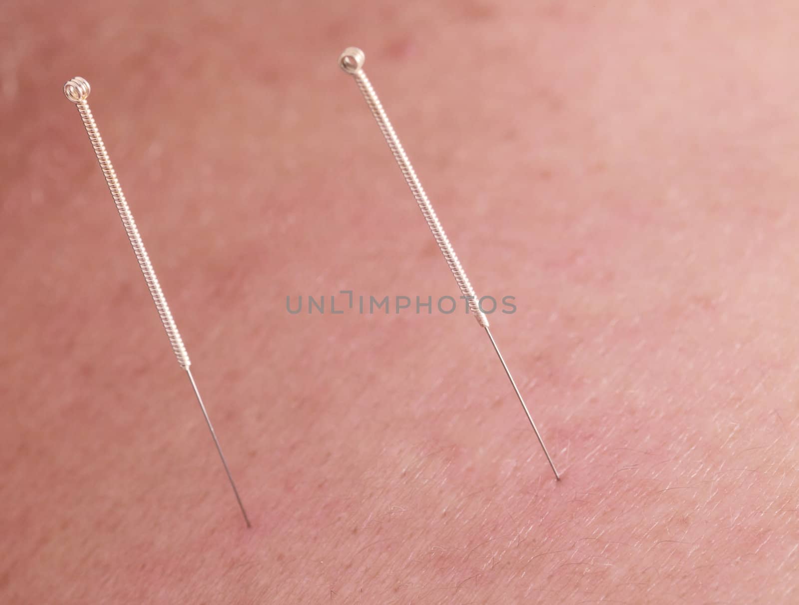 Macro image of two acupuncture needles in the skin of a pacient.