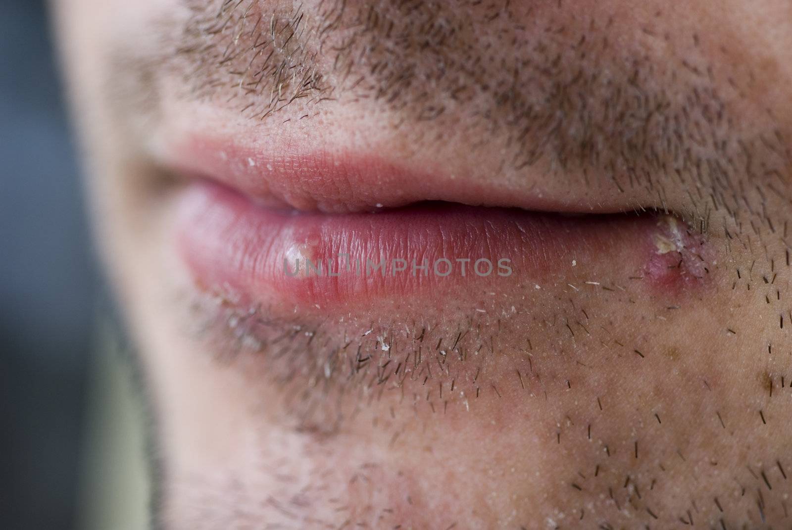 Cold sores (herpes labialis) by stockarch
