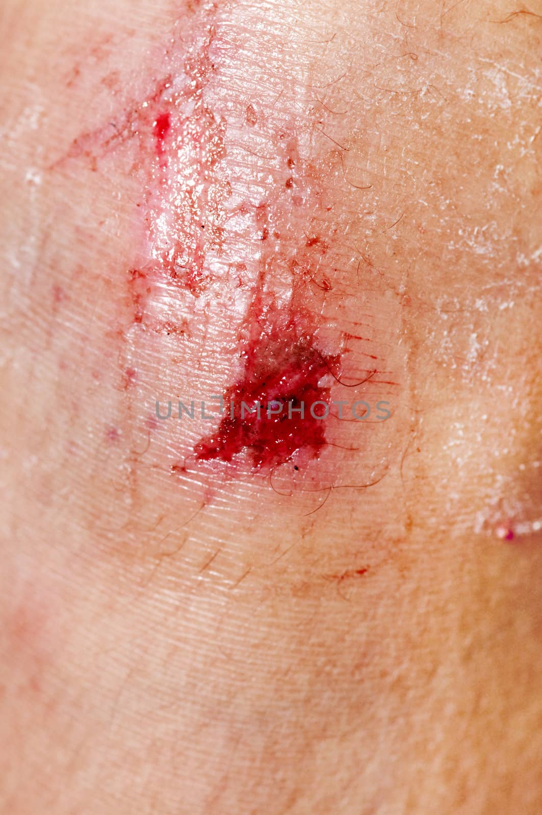 Close up on an adult scraped knee after fell down.
