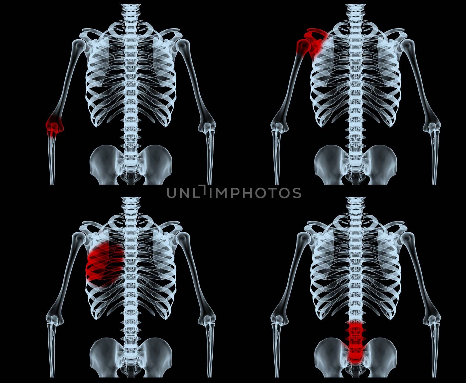 3d rendered body with painful areas