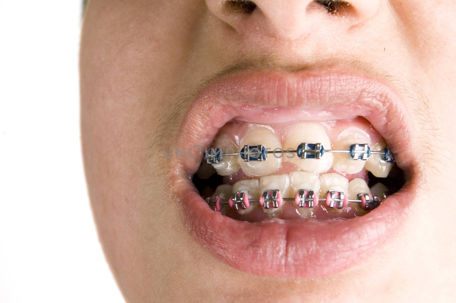 colourfull dental braces

