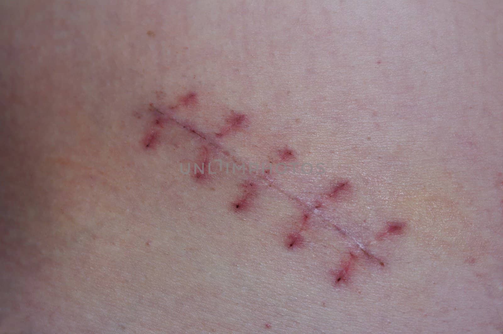 scar and seams after operation