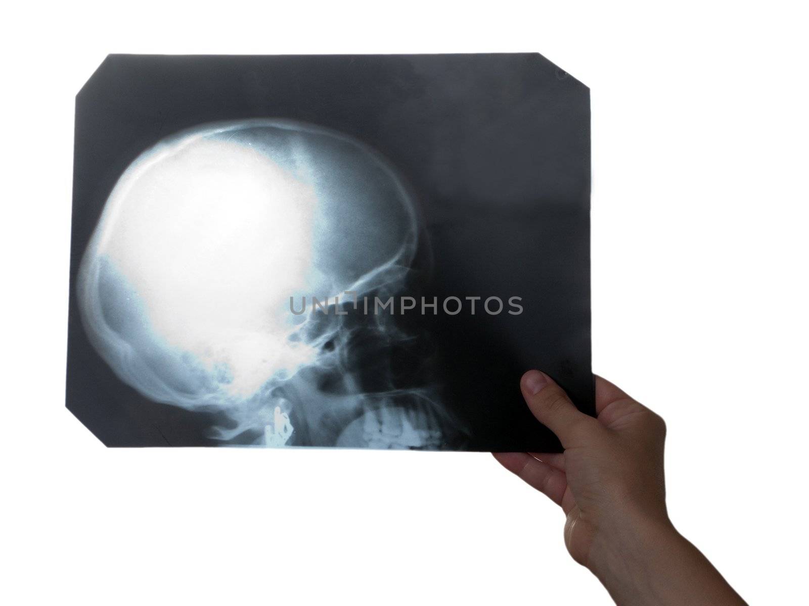 X-ray medicine film of human skull bone in hand