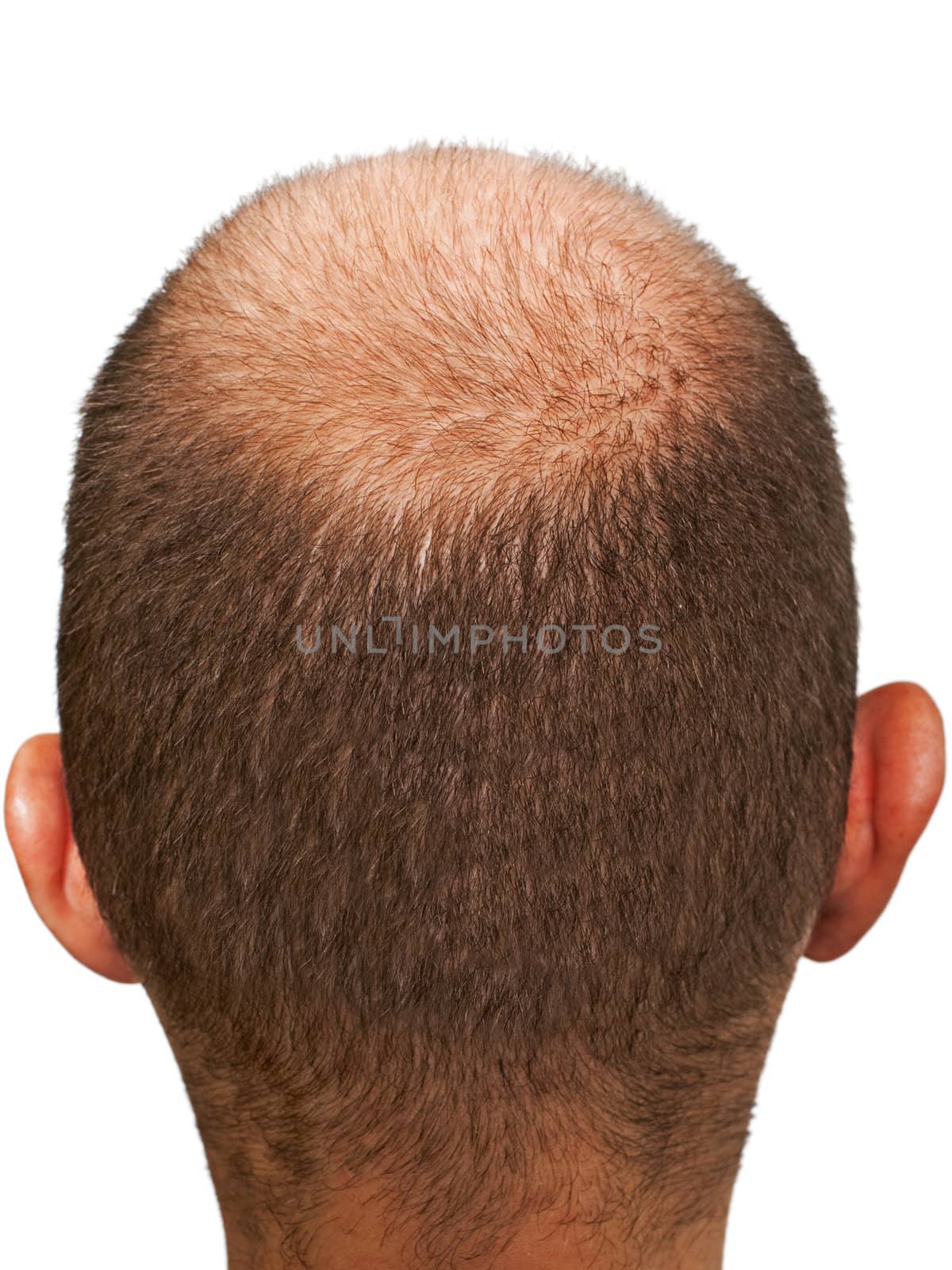Bald hair head of adult men completely balding