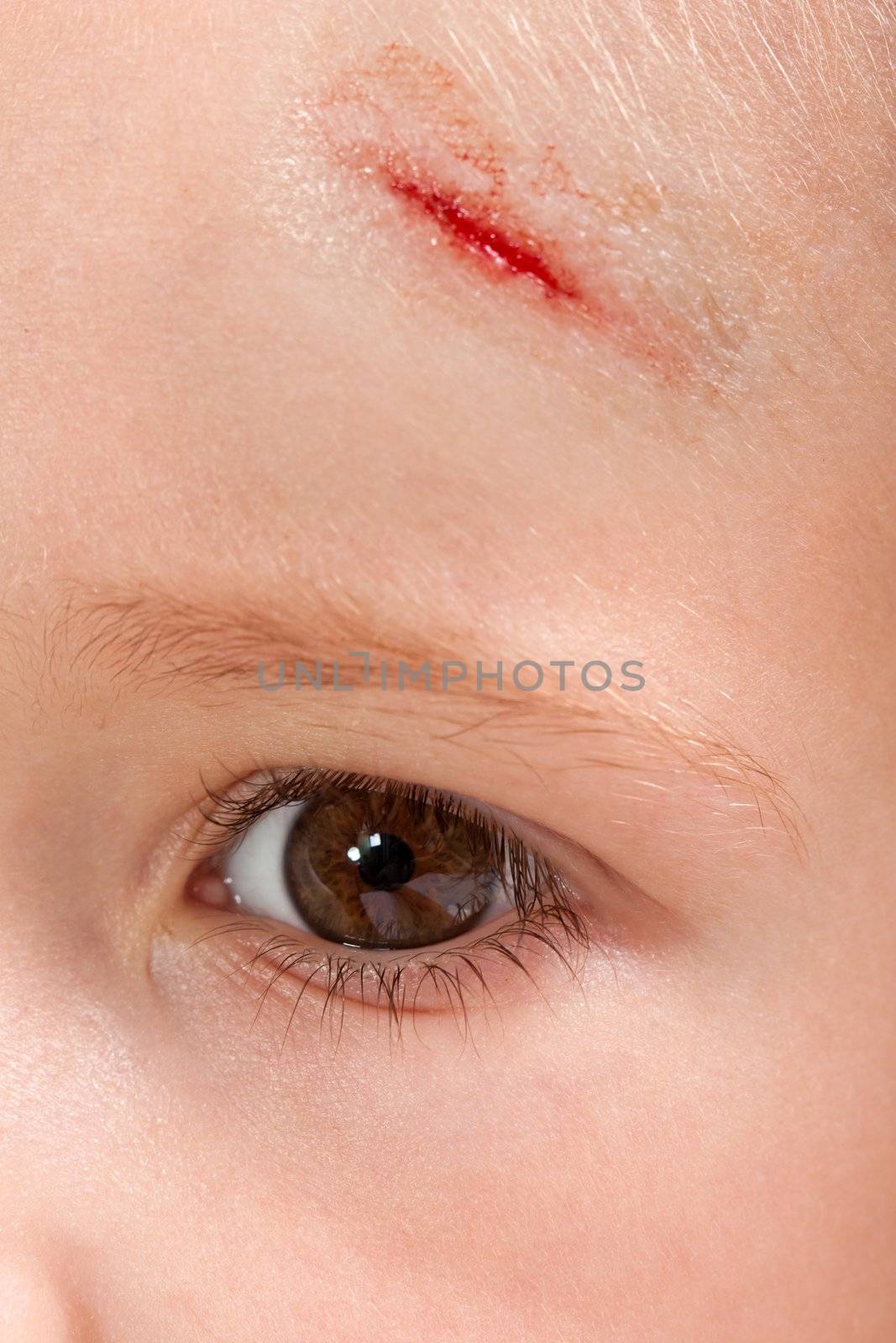 Physical injury blood wound skin human child pain