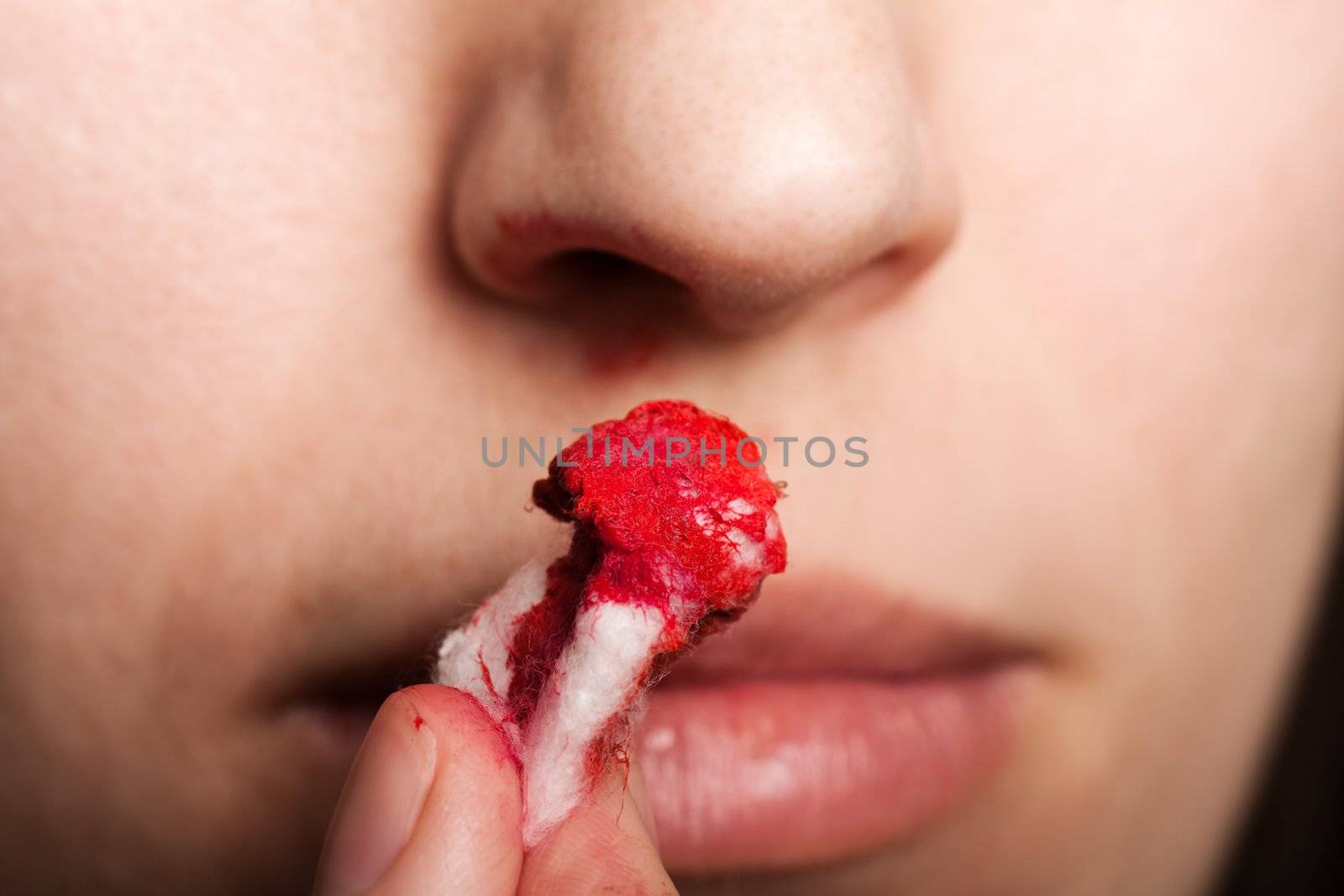 Wound nosebleed - adult human nose injury blood