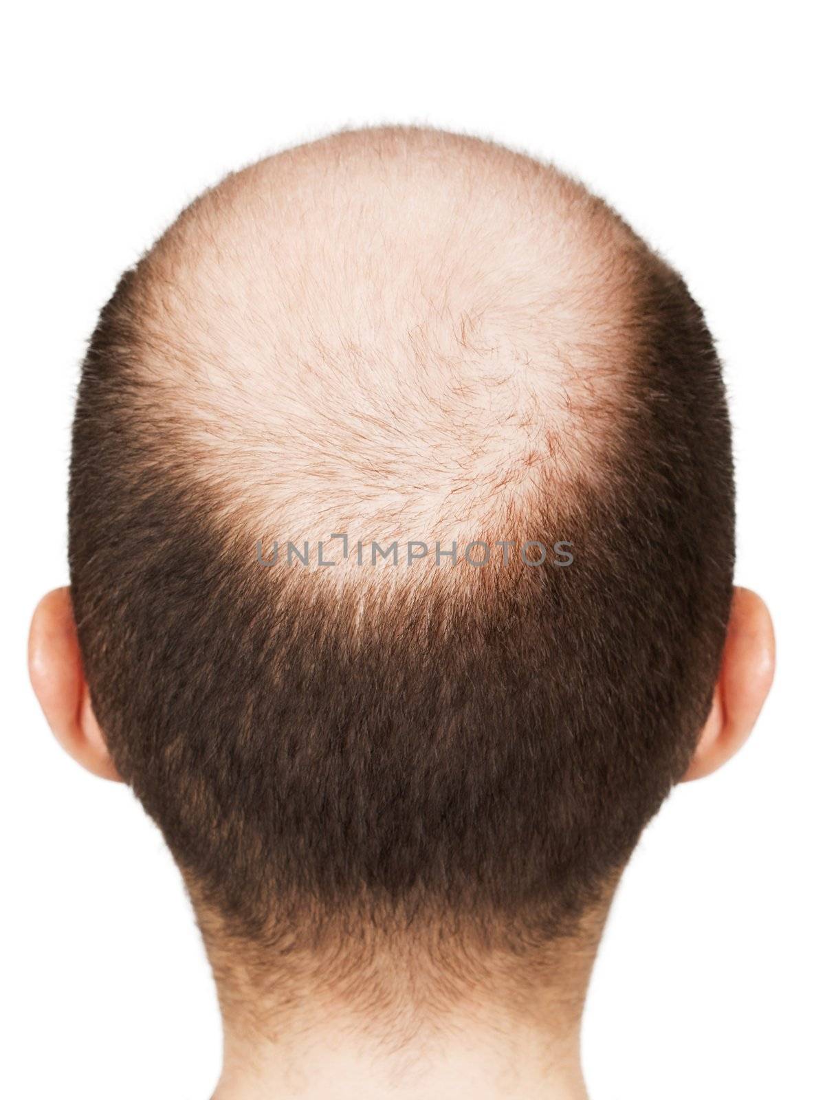 Bald men head by ia_64