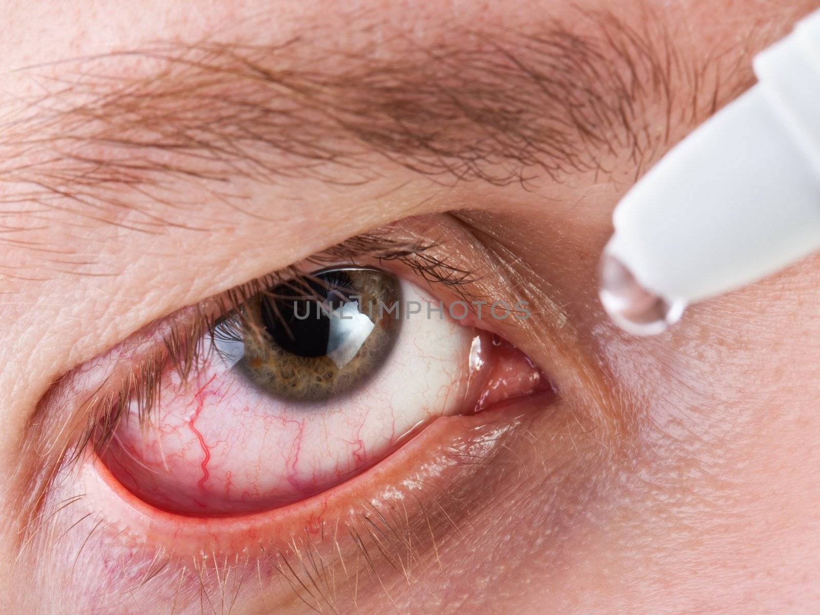 Medicine healthcare liquid eyedropper on human eye