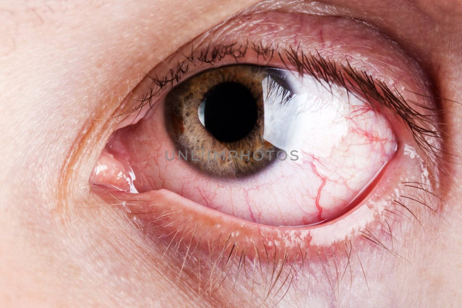 Medicine healthcare blood capillary human eye pain