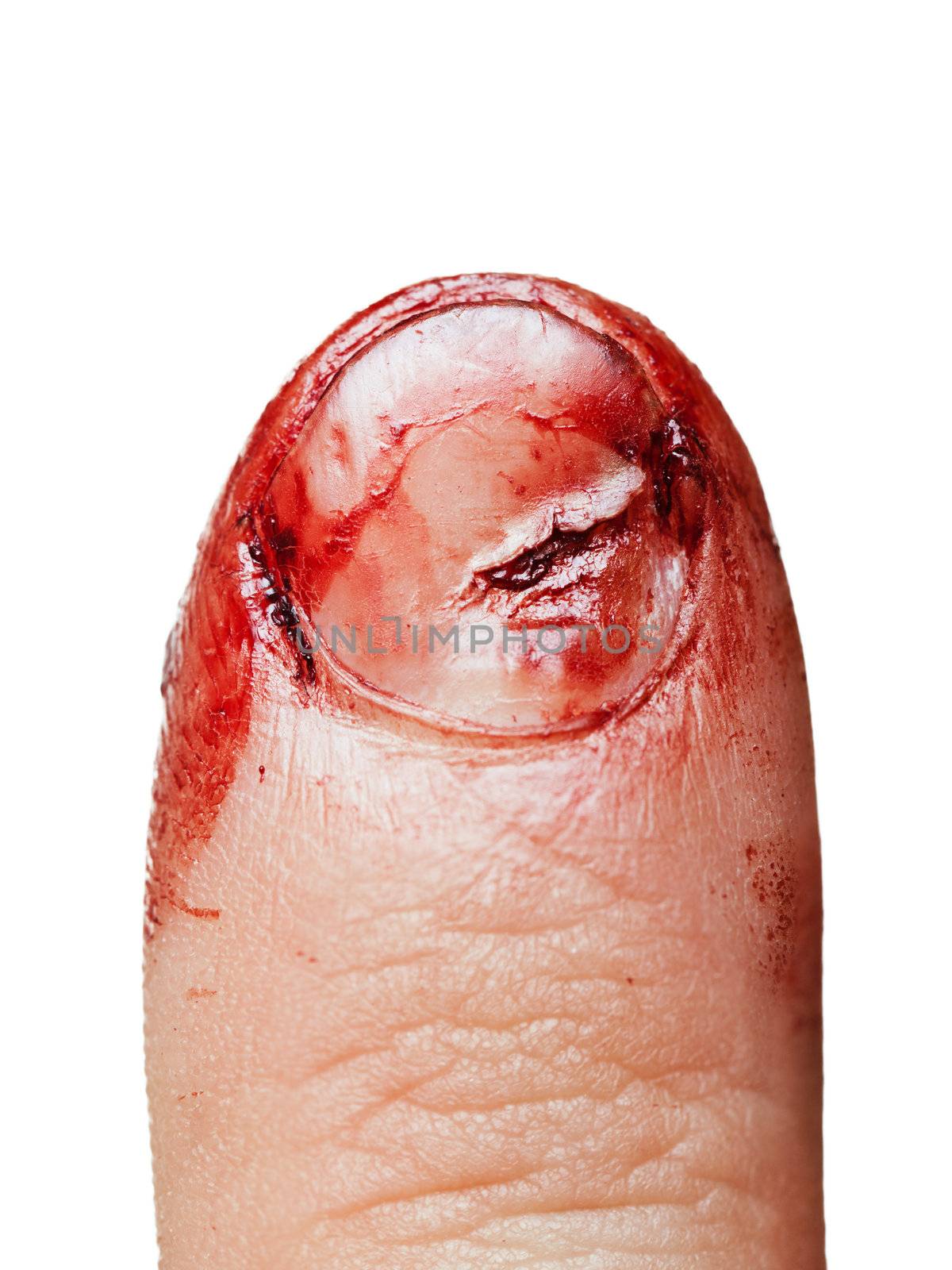 Physical injury blood wound human hand finger nail