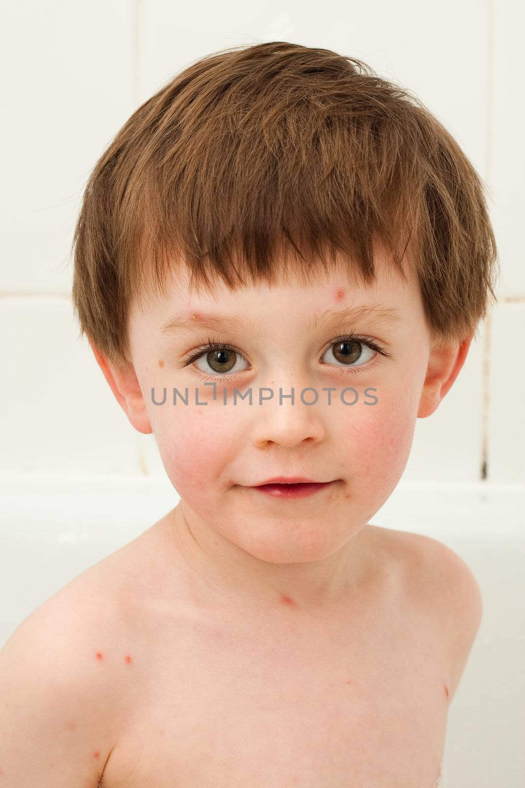 little boy with chicken pox