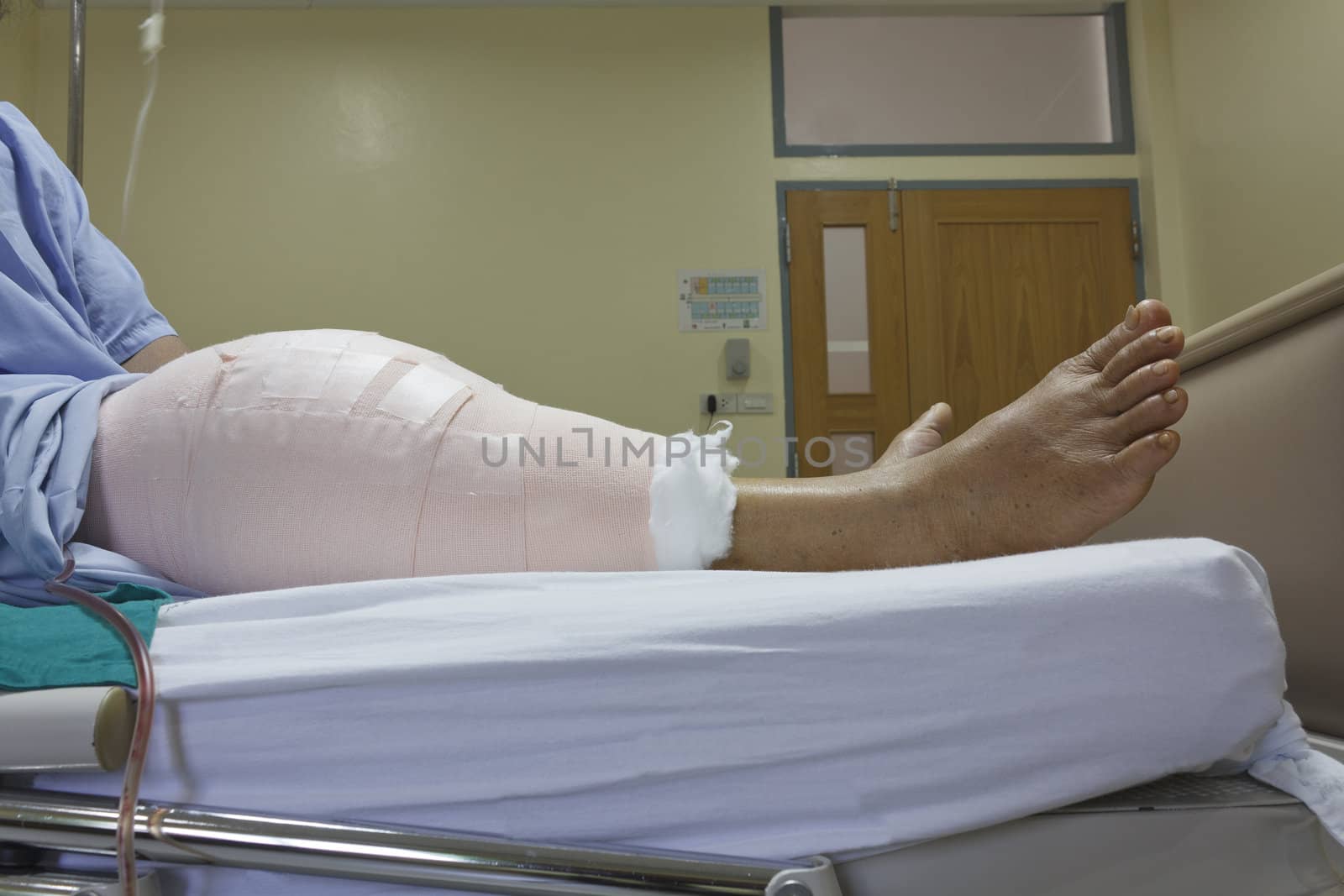 Knee replacement surgery after operation patient senior woman (60s) on the bed in hospital